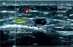 Abnormalities of the Saphenous Nerve at the Ankle