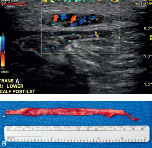 Plantar Fasciitis and Other Abnormalities of the Plantar Fascia