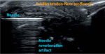 Achilles Tendinitis and Other Abnormalities of the Achilles Tendon