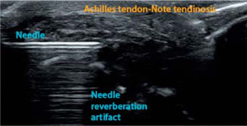 Achilles Tendinitis and Other Abnormalities of the Achilles Tendon