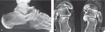 Arthritis and Other Abnormalities of the Subtalar Joint