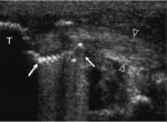 Posterior Tibialis Tendinitis and Other Abnormalities of the Posterior Tibialis Tendon