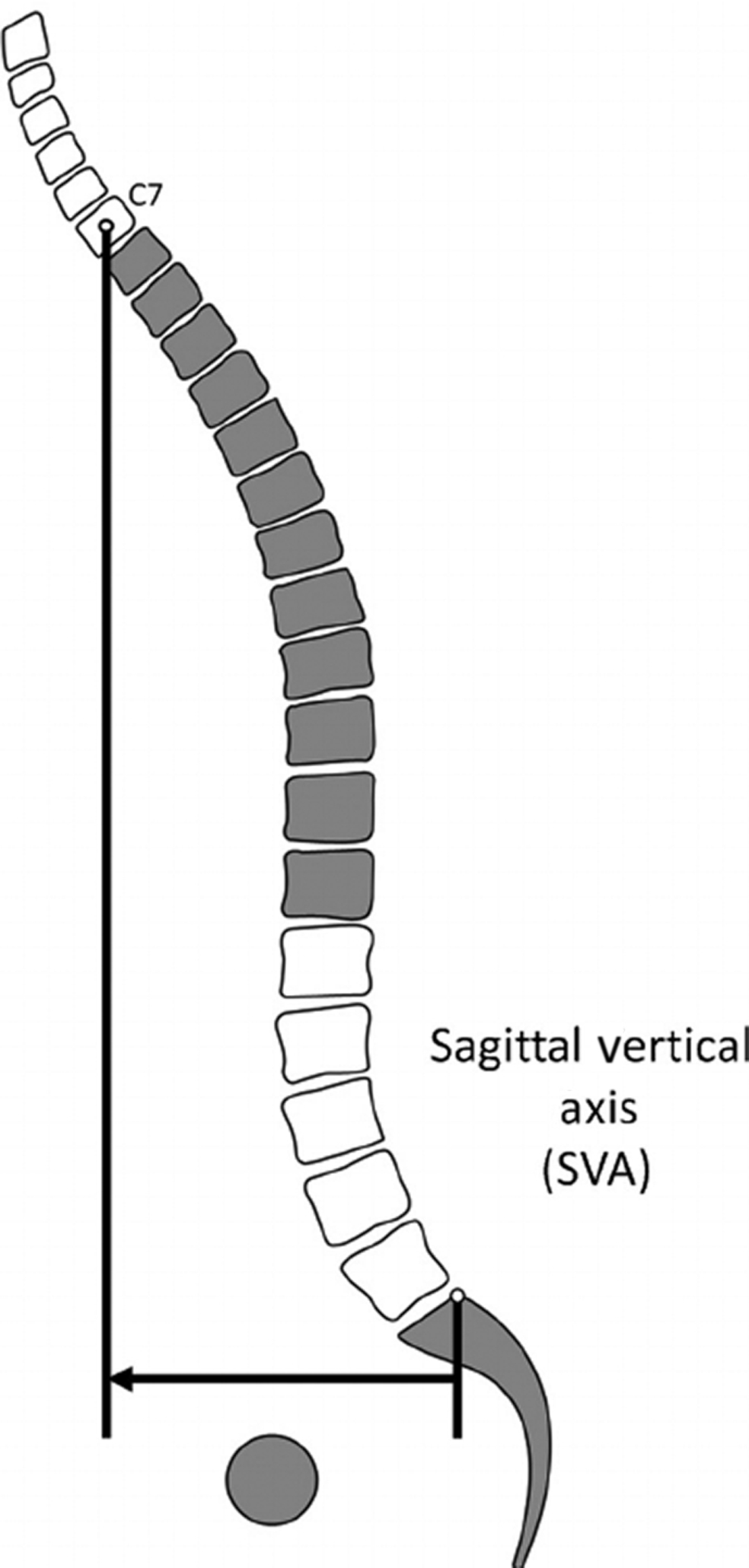 A Novel Radiographic Classification Of Severe Spinal Curvatures Zohal