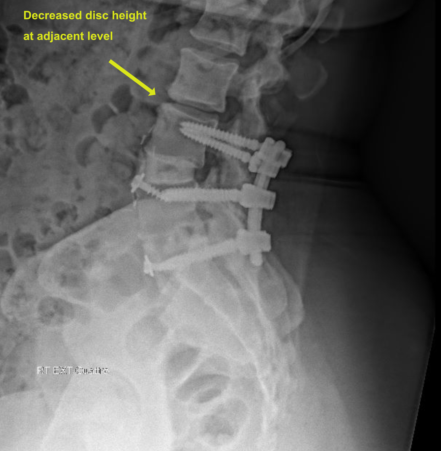 Lumbosacral spine x-ray Information