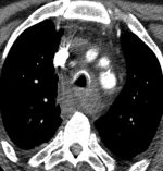 Imaging of the Middle and Visceral Mediastinum