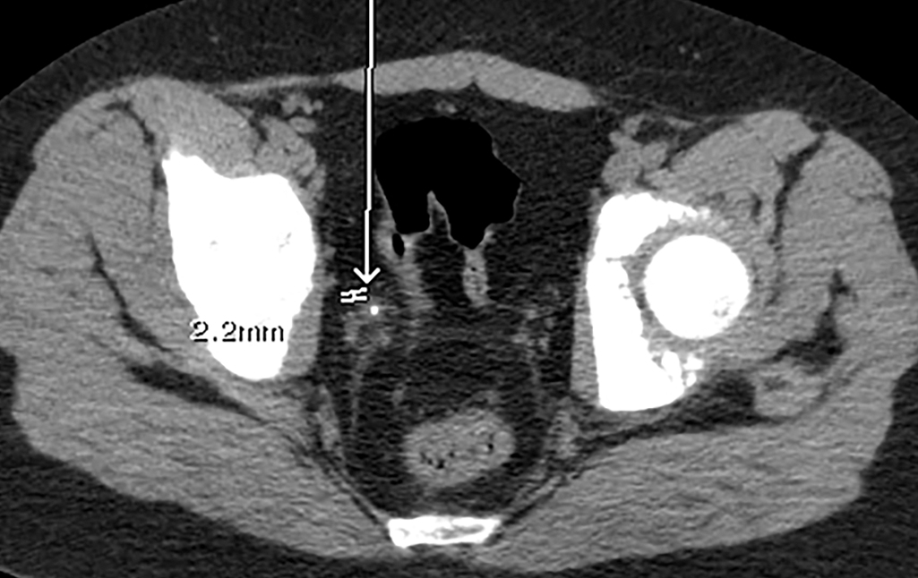 All pain and no gain: Renal stones | Radiology Key