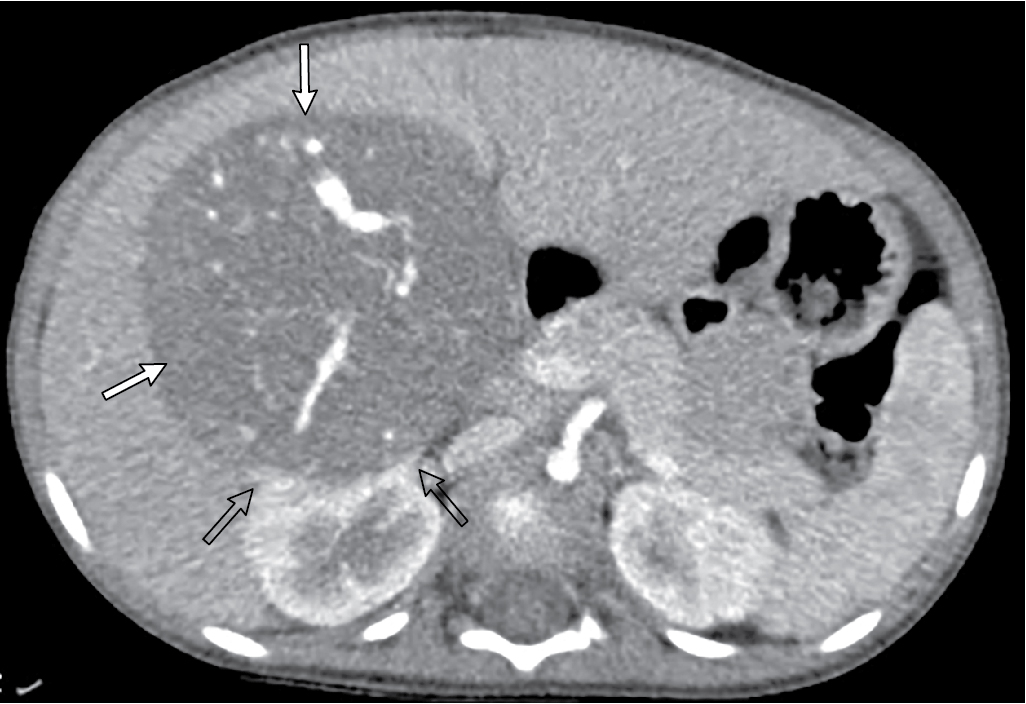 Belly getting bigger? Wilms tumor | Radiology Key