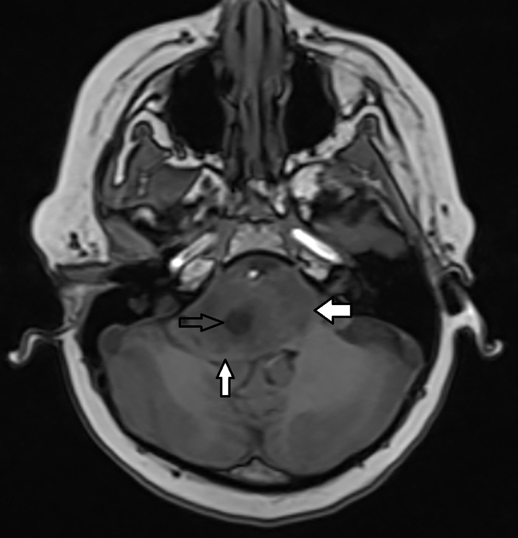 Diffuse intrinsic pontine glioma: DIPG | Radiology Key