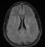 Not actin’ right: Lacunar infarct and pediatric stroke