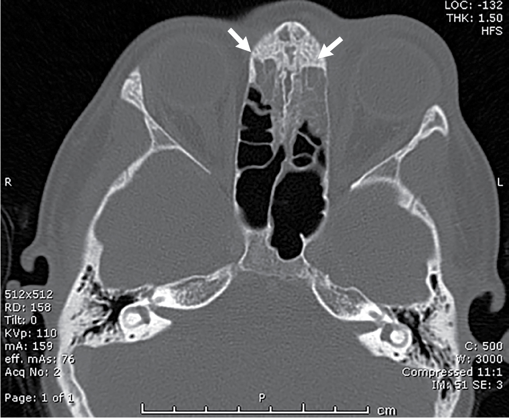 Can You See It? Orbital Cellulitis 