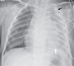 Rattlin’ in the chest: Community-acquired pneumonia