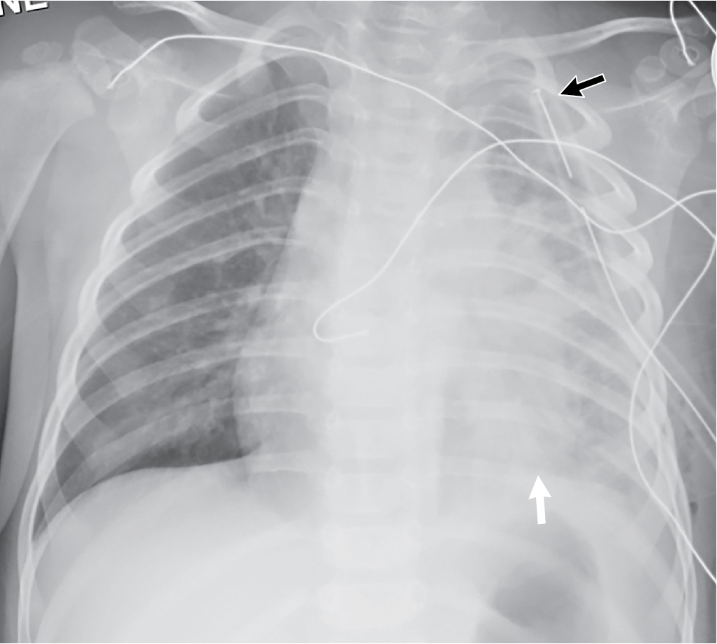 Rattlin’ in the chest Communityacquired pneumonia Radiology Key