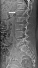My achin’ back: Vertebral compression fractures