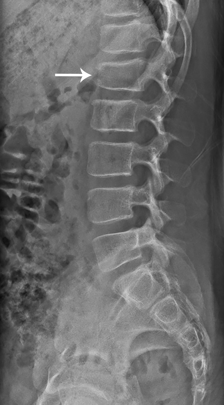 Types Of Lumbar Spine Fractures Radiology - Printable Online