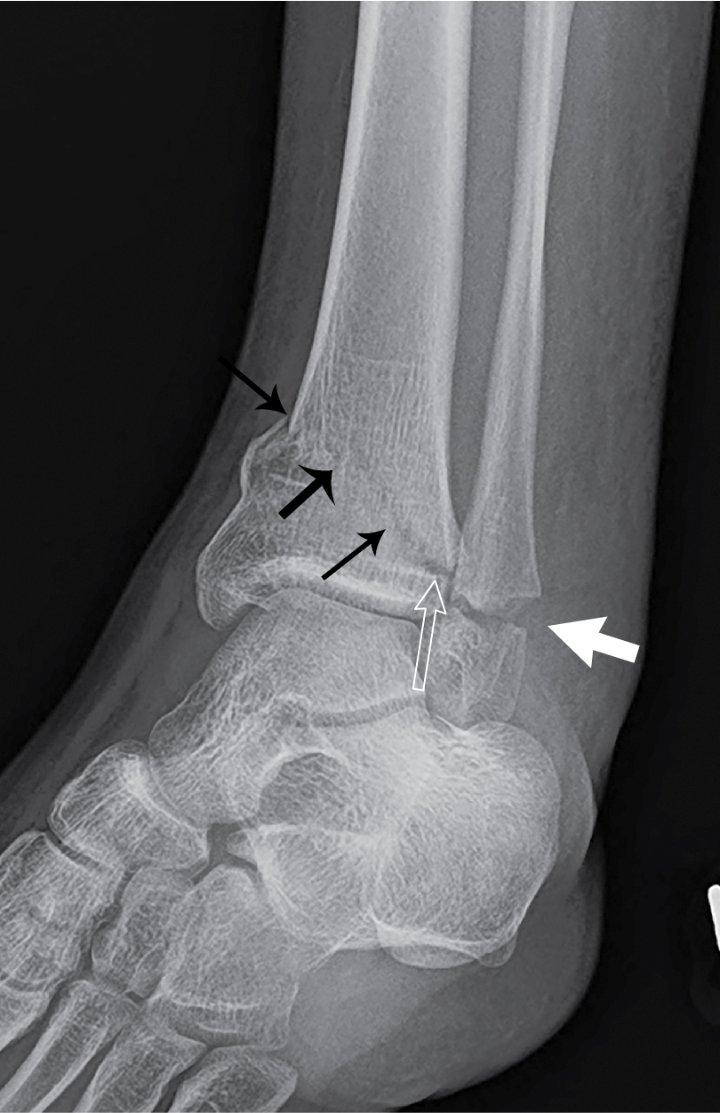 Growing pains: Salter-Harris classification of physeal injuries