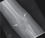 My fracture is not humerus: Supracondylar fractures