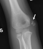 Elbow grease: Lateral and medial condyle fractures of the humerus