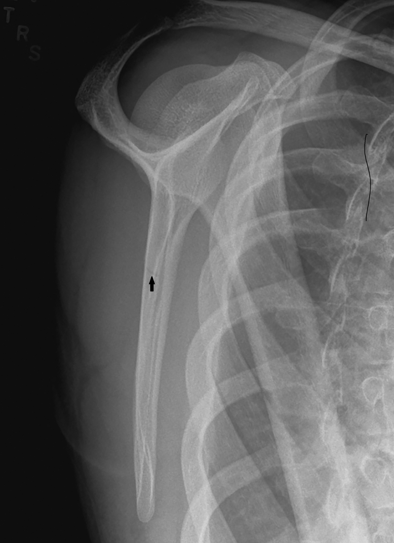 Scapula Fracture Protocol at Benjamin Michele blog