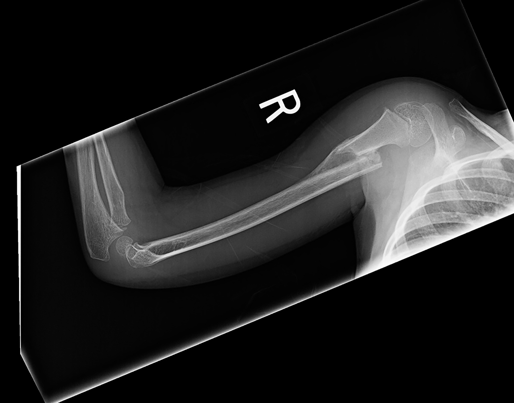 Humeral shaft fractures: Nothing funny about that! | Radiology Key