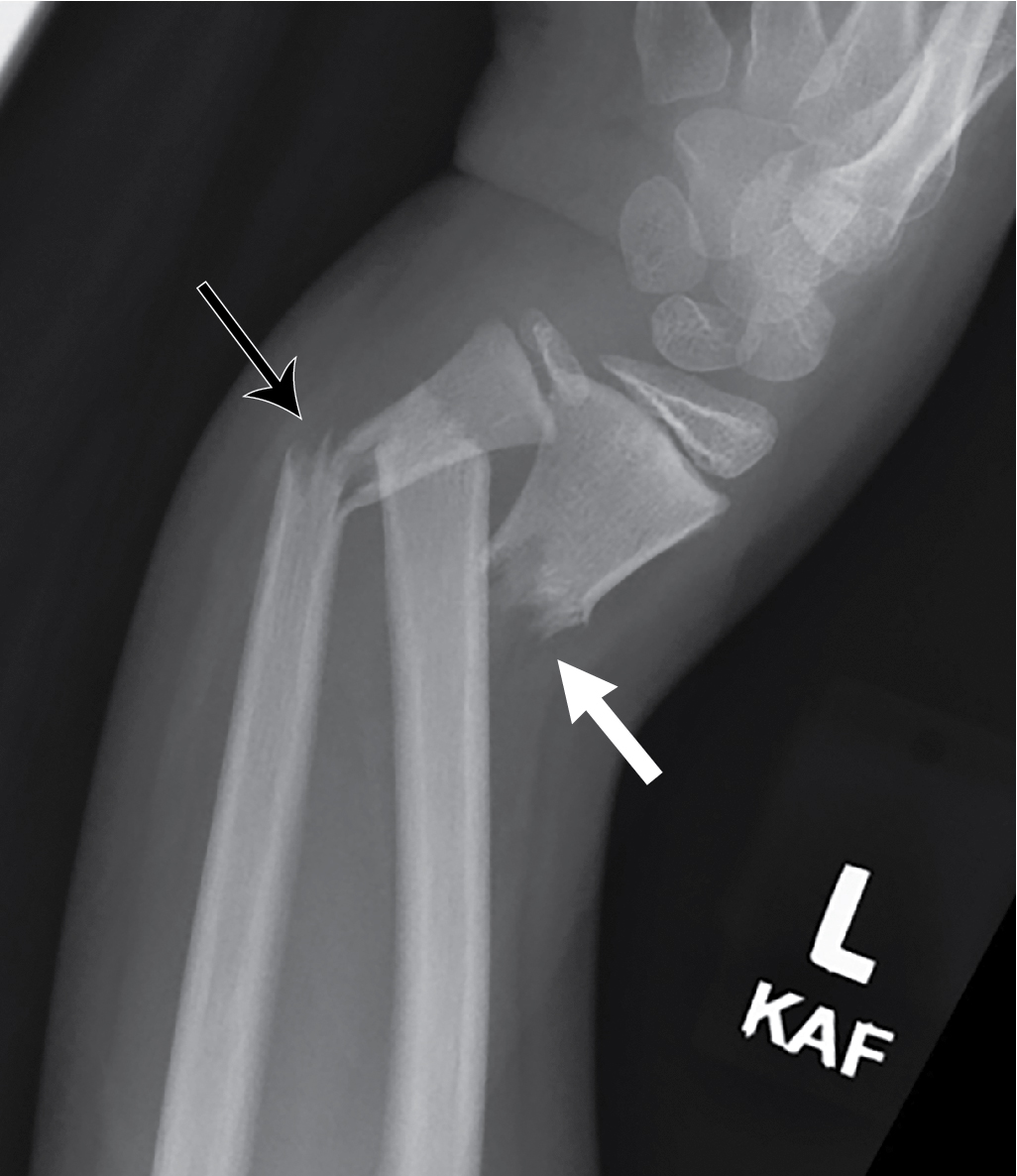 Proximal Forearm Fracture