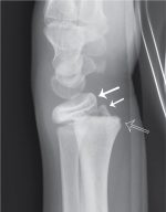 Bones out of place? Wrist fractures