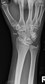 Snuffbox? Scaphoid fractures