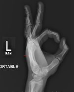 Punchin’ out: Fifth metacarpal (boxer’s) fracture