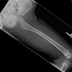 All fun and games: Femoral fractures