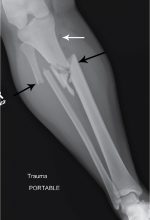 It’s the way you (don’t) walk: Fractures of the tibia and fibula