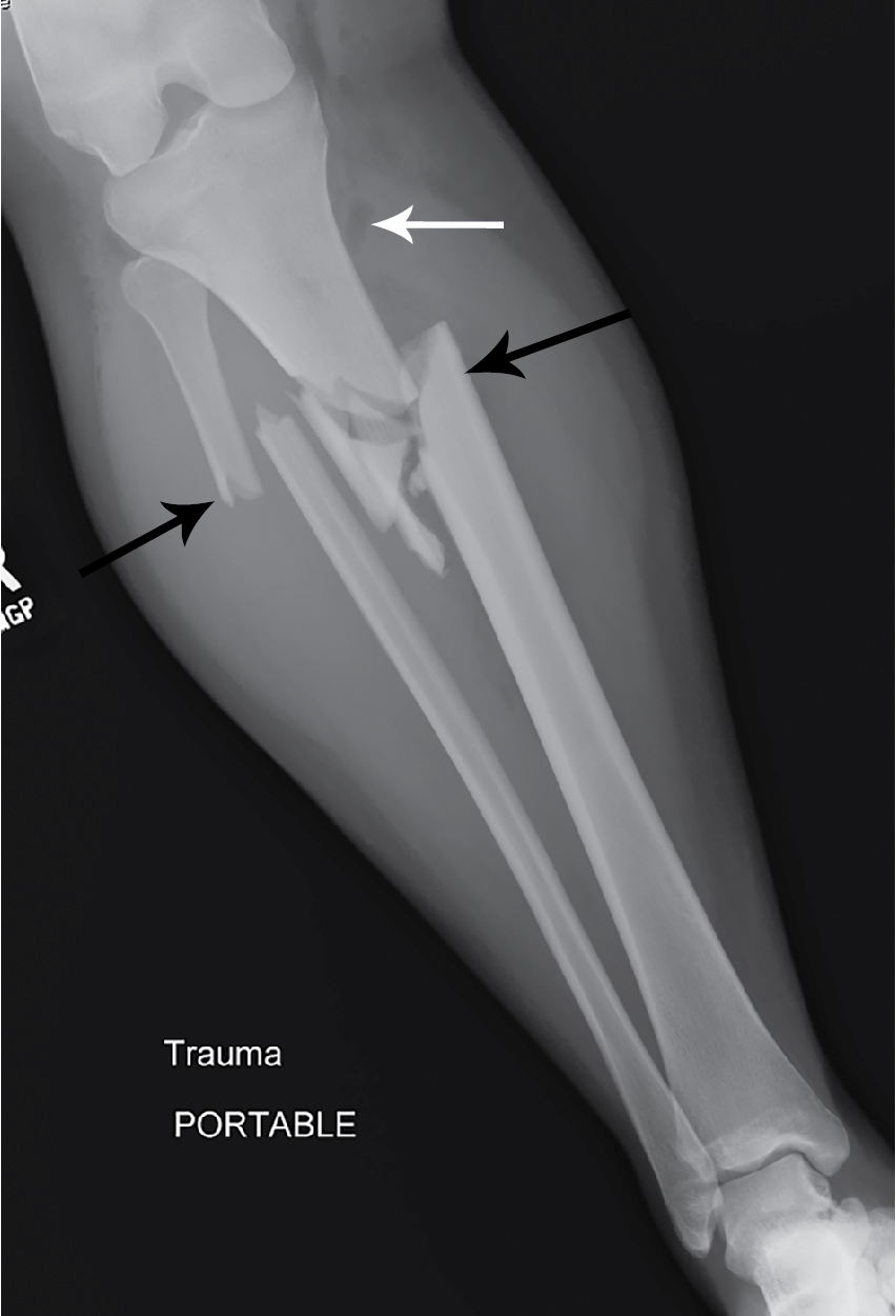 comminuted fracture tibia and fibula