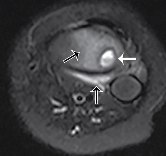 Who s Brodie Brodie abscess Radiology Key