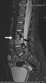 More than an achy back: Spinal epidural abscess