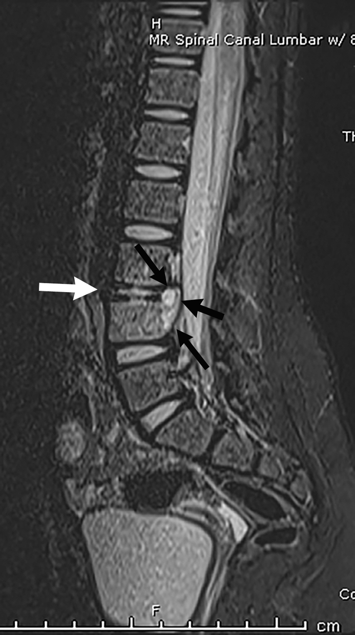 epidural site pain years later