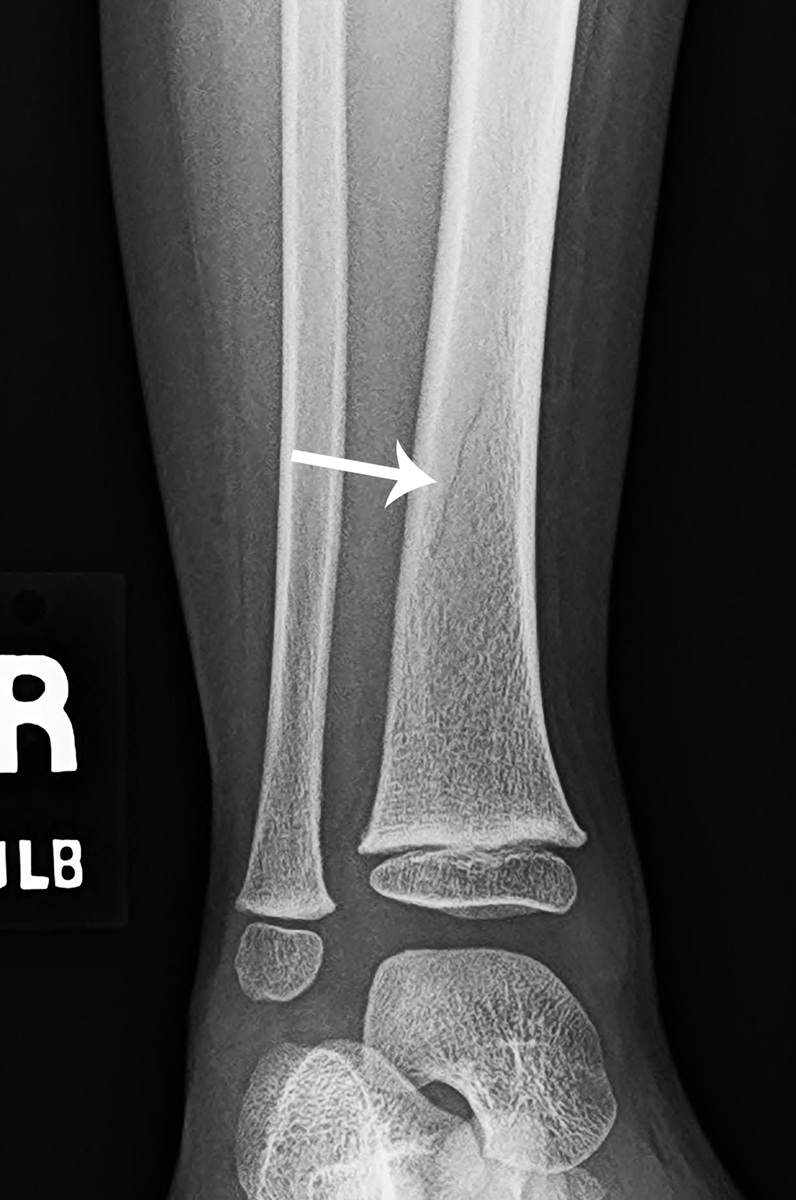 It’s tough being a kid: Toddler’s fracture | Radiology Key
