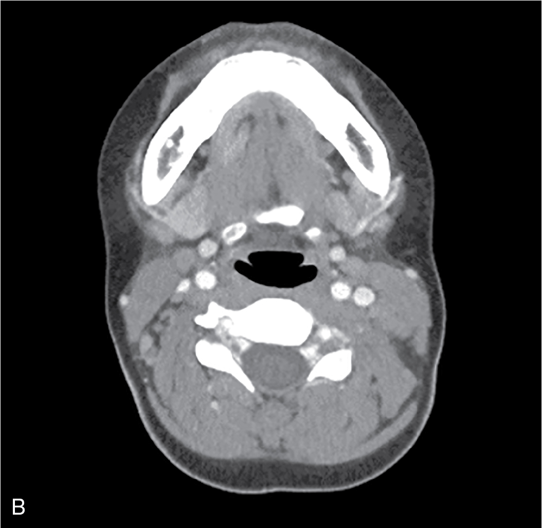 Frog In Your Throat Supraglottic Infections And Bacterial Tracheitis 