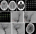 Computed Tomography–Based Imaging Algorithms for Patient Selection in Acute Ischemic Stroke
