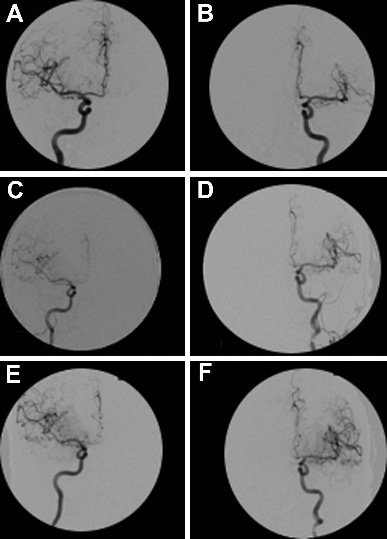 Vasospasm Radiology Key