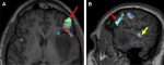 Utility of Preoperative Blood-Oxygen-Level–Dependent Functional MR Imaging in Patients with a Central Nervous System Neoplasm