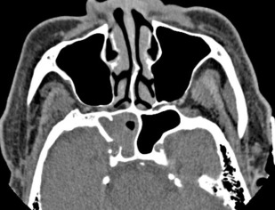 Fungal Sinusitis | Radiology Key