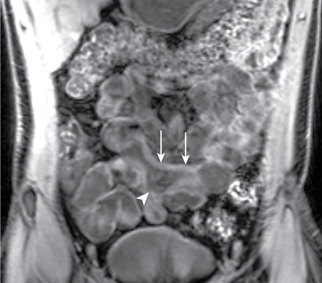 bowel-wall-thickening-radiology-key