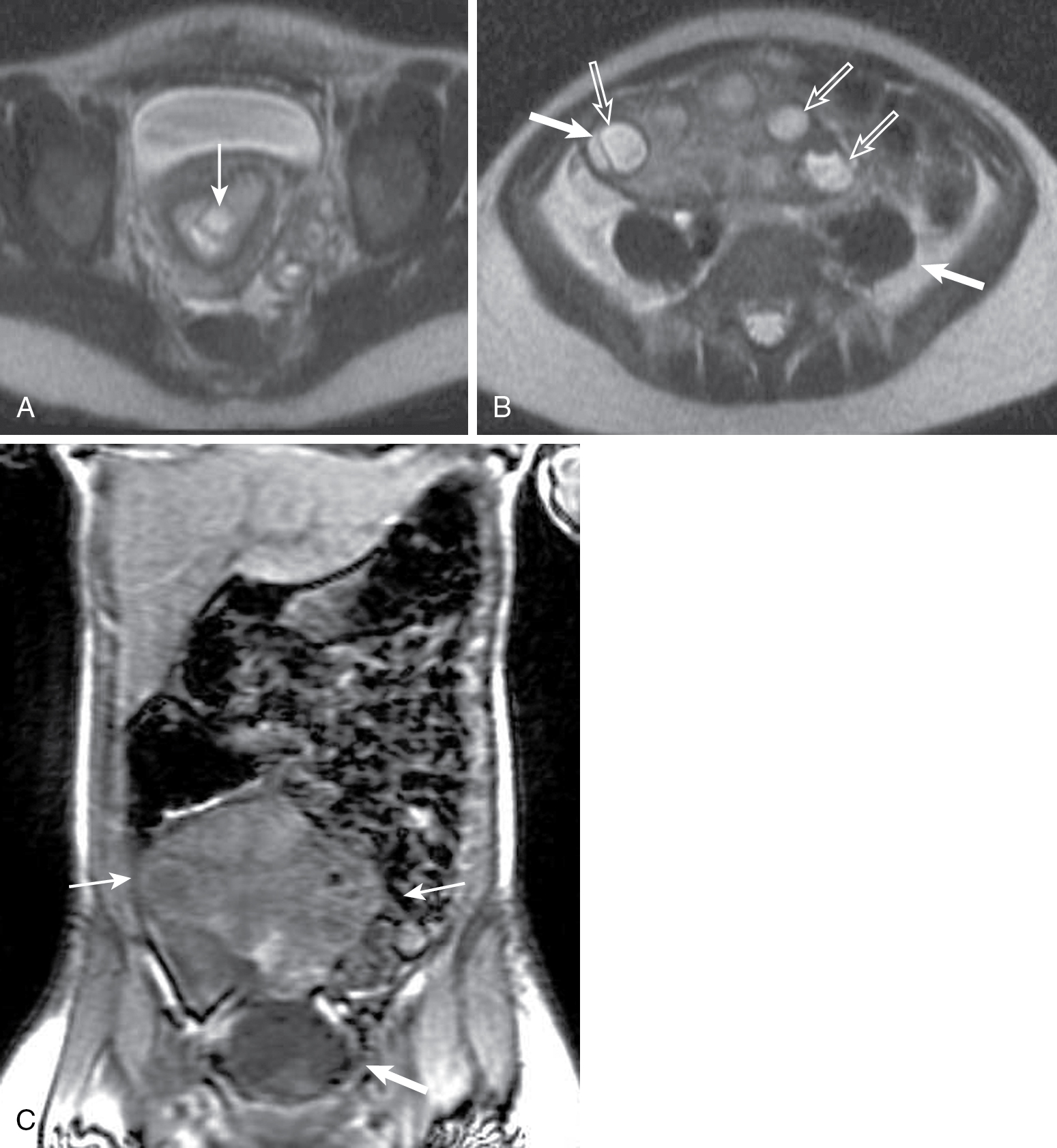 right-lower-quadrant-pain-radiology-key