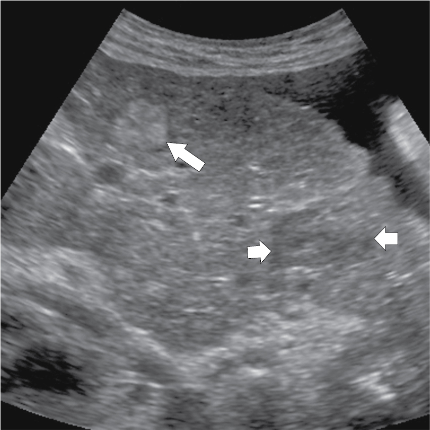 Imaging of the cirrhotic liver | Radiology Key