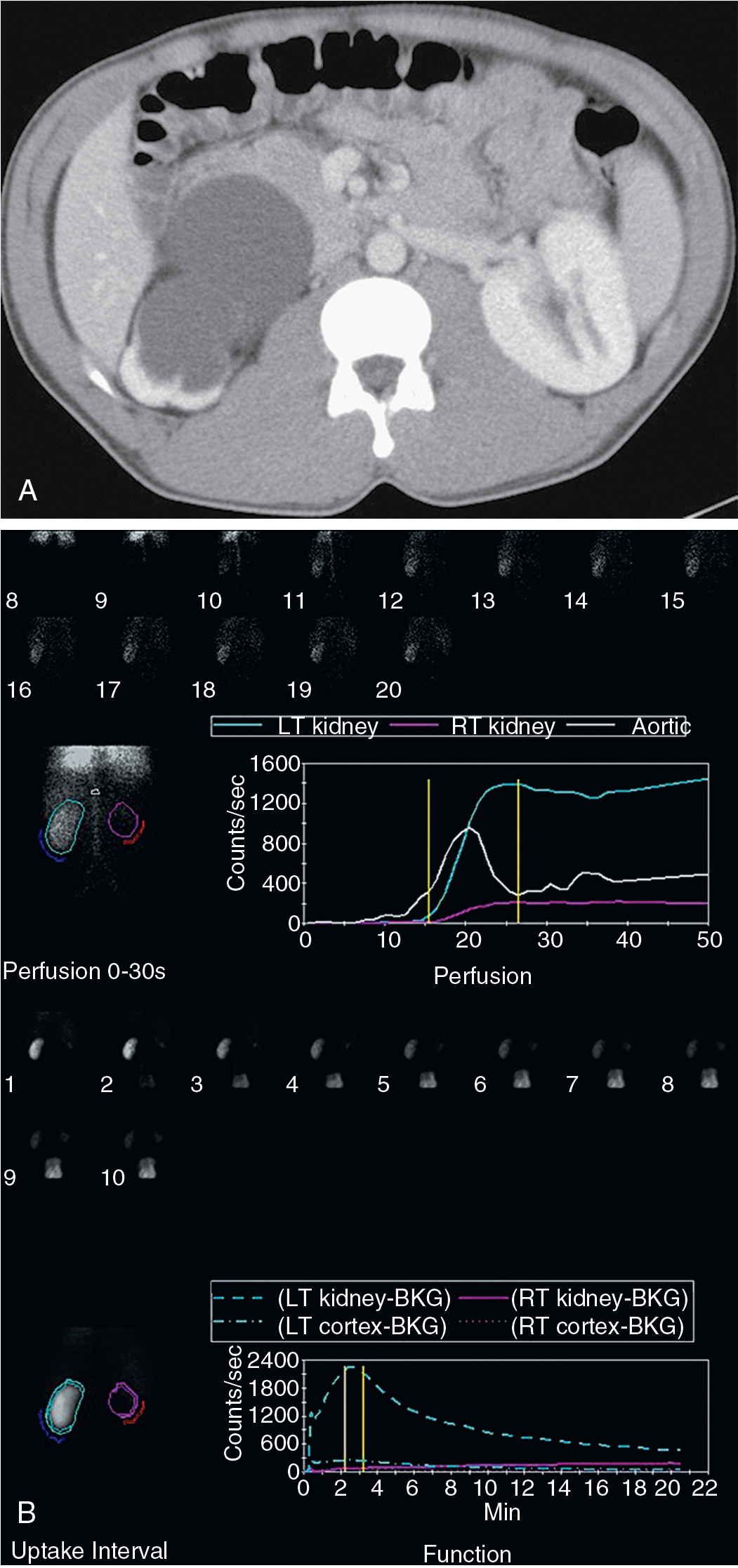 Urinary Tract Obstruction Radiology Key