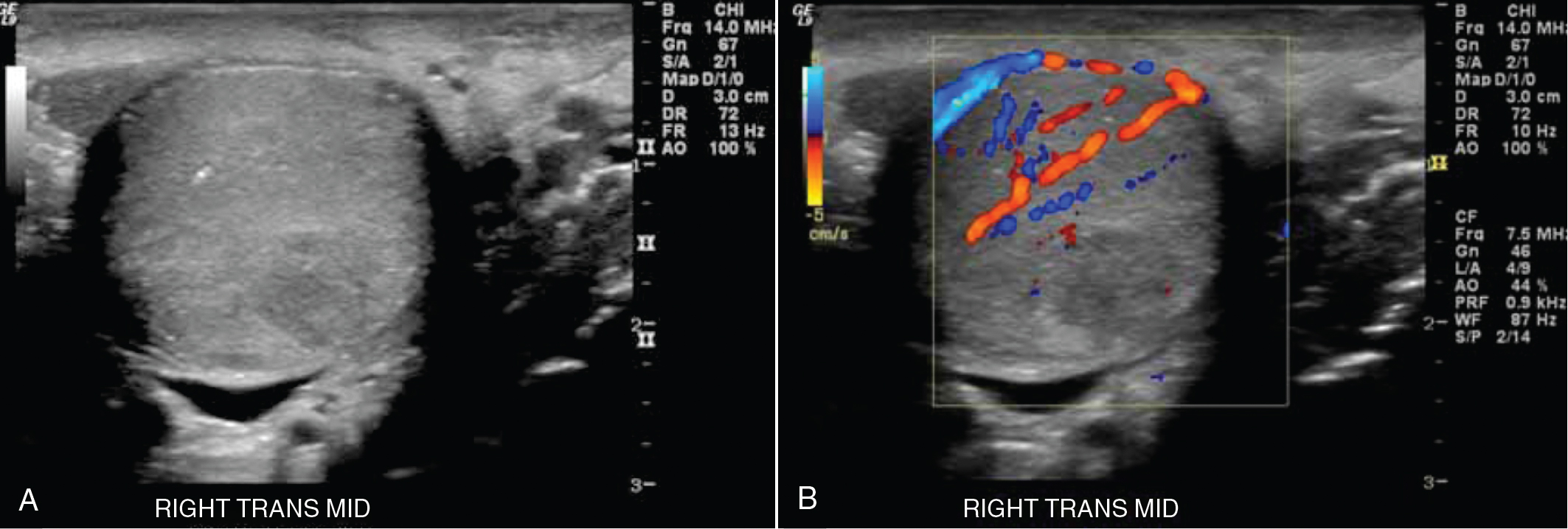 Testicular Lesions Radiology Key 3510