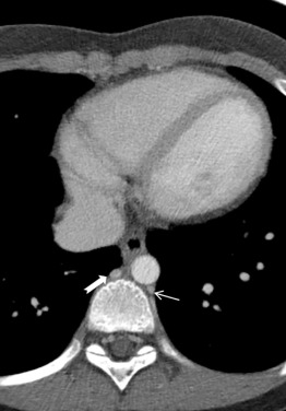 Imaging Anatomy of the Heart and Thoracic Great Vessels | Radiology Key
