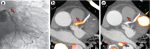 Coronary Artery Vessel Wall Imaging and Future Directions