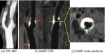 Carotid Vessel Wall Imaging and Future Directions
