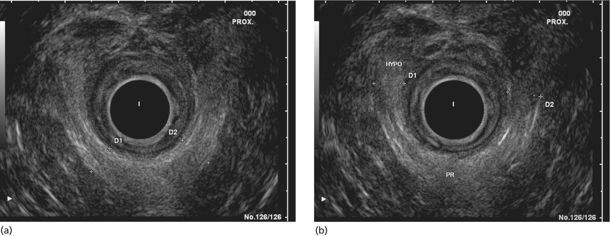 Photos depict (a) Levator ani muscle with the puborectal part (PR) in between markers. (b) The more distant parts of this muscle often show a more inhomogeneous and hypoechoic appearance (Hypo).