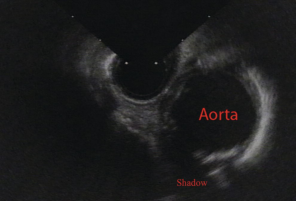 Photo depicts a radial array endoscopic ultrasound image of a calcific aortic plaque. The area behind the plaque is shadowed out.