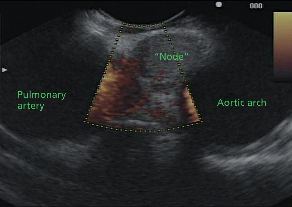Photo depicts a linear array image of the aortopulmonary window with an isoechoic mass that was demonstrated on the video to be a pseudoaneurysm.